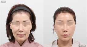 Before and after blepharoplasty results at AB Plastic Surgery, visible eyelid correction