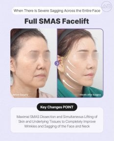Before and after SMAS facelift results at AB Plastic Surgery – improved facial sagging and wrinkles