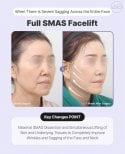 Before and after SMAS facelift results at AB Plastic Surgery – improved facial sagging and wrinkles