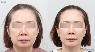 Blepharoplasty before and after results at AB Plastic Surgery, eyelid correction for youthful look