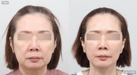 Blepharoplasty before and after results at AB Plastic Surgery, eyelid correction for youthful look