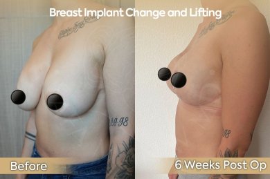 before-after photo mastopexy-breast-lift-contour-plastics