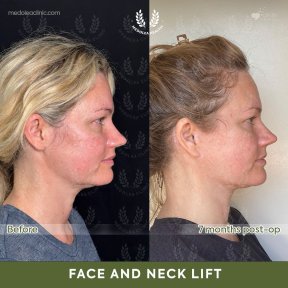 before-after photo deep-plane-facelift