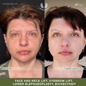 before-after photo deep-plane-facelift