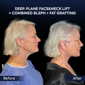 before-after photo deep-plane-facelift