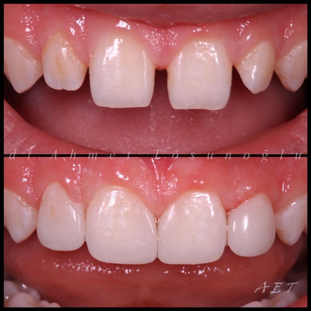 Resultados antes y después de relleno compuesto: mejora en forma y estética dental frontal