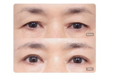 Before and after upper and lower eyelid surgery results at AB Plastic Surgery clinic
