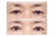 Before and after upper and lower eyelid surgery results at AB Plastic Surgery clinic