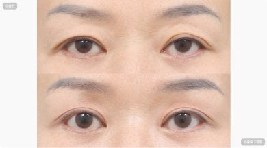 نتائج جراحة الجفن العلوي والسفلي في AB Plastic Surgery، عيون أكثر شباباً