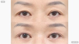نتائج جراحة الجفن العلوي والسفلي في AB Plastic Surgery، عيون أكثر شباباً