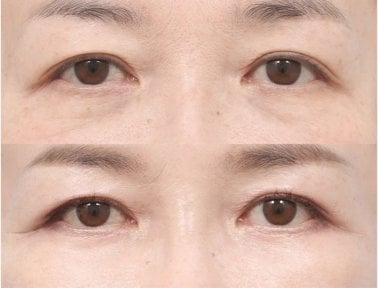 Before and after upper and lower eyelid surgery results at AB Plastic Surgery, rejuvenated eyes