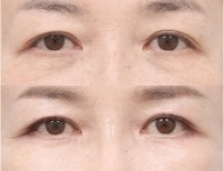 Before and after upper and lower eyelid surgery results at AB Plastic Surgery, rejuvenated eyes