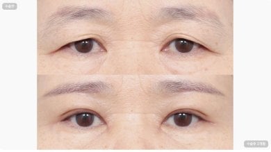 Before and after upper and lower eyelid surgery results at AB Plastic Surgery, rejuvenated eyes