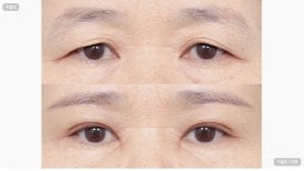 Before and after upper and lower eyelid surgery results at AB Plastic Surgery, rejuvenated eyes