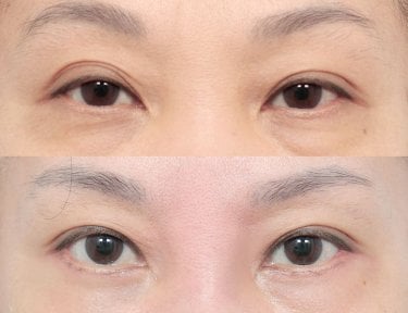 نتائج جراحة الجفون العلوية والسفلية قبل وبعد في AB Plastic Surgery، تجديد شباب العينين