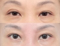 نتائج جراحة الجفون العلوية والسفلية قبل وبعد في AB Plastic Surgery، تجديد شباب العينين
