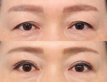 نتائج جراحة الجفون العلوية والسفلية في AB Plastic Surgery، عيون أكثر شباباً