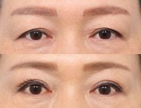 نتائج جراحة الجفون العلوية والسفلية في AB Plastic Surgery، عيون أكثر شباباً