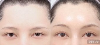 Before and after upper and lower eyelid surgery results at AB Plastic Surgery, visible eye rejuvenation