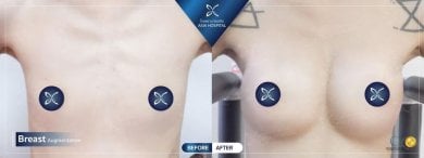 Before and after breast implant revision results at Asia Cosmetic Hospital, enhanced breast shape