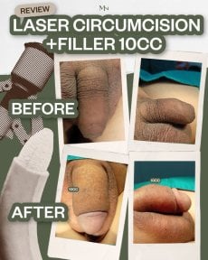 Before and after results of laser circumcision and penis filler at Menness Wellness Clinic