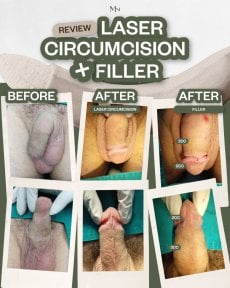 Before and after laser circumcision and penis filler results at Menness Wellness Clinic