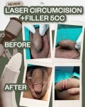 Before and after penis enlargement with laser circumcision and 5cc filler at Menness Wellness Clinic