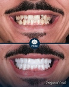 До и после установки виниров Emax в Inci Dis International, результат Голливудской улыбки