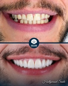 До и после установки виниров Emax в Inci Dis International – результат Hollywood Smile