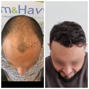 before-after photo hair-transplant