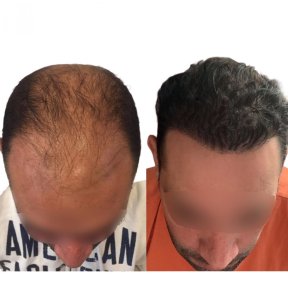 before-after photo hair-transplant