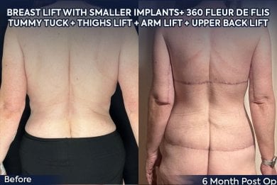 before-after photo arms-plastics-brachioplasty