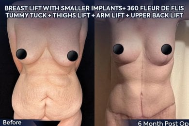 before-after photo arms-plastics-brachioplasty