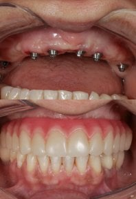 before-after photo all-on-6-dental-implants