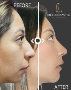 before-after photo rinoplastika-plastika-nosa
