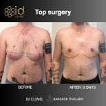 Before and after top surgery results at ID Clinic Bangkok, 8 days post chest masculinization
