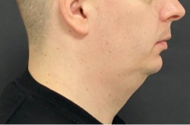 before-after photo sliding-genioplasty