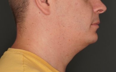 before-after photo sliding-genioplasty