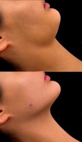 before-after photo rhinoplasty-nose-job
