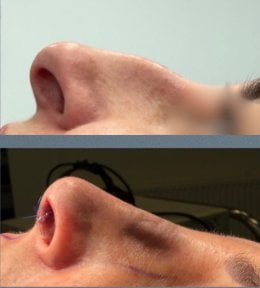 before-after photo rhinoplasty-nose-job