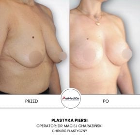 before-after photo umensenie-grudi
