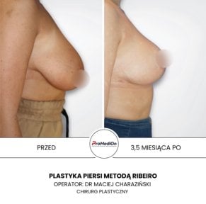 before-after photo umensenie-grudi