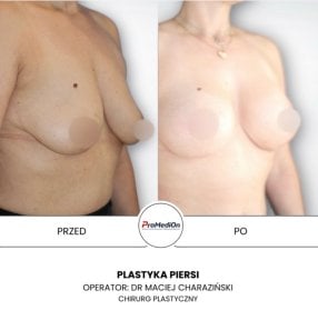 before-after photo umensenie-grudi