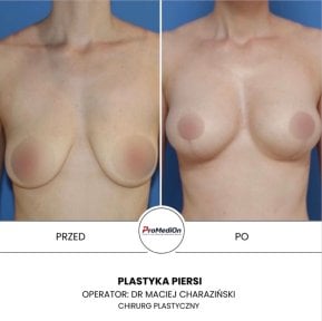 before-after photo umensenie-grudi