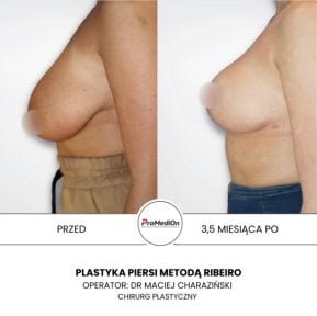 before-after photo umensenie-grudi