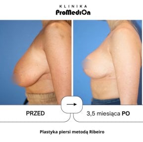 before-after photo umensenie-grudi