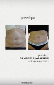 before-after photo abdominoplasty