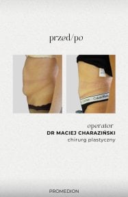 before-after photo abdominoplasty
