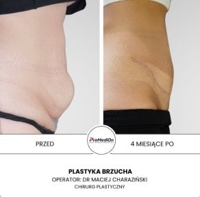 before-after photo abdominoplasty