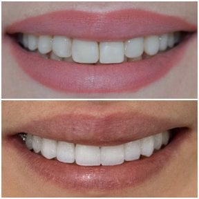 before-after photo composite-veneer